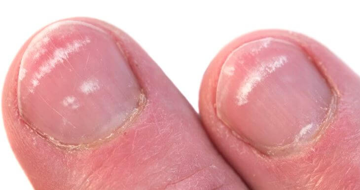 niedobór białka w diecie - białe plamy na paznokciach